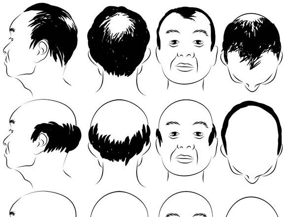头发种植有三种技术（4种方法教你种植头发）(3)