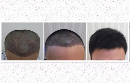 头发种植有三种技术（4种方法教你种植头发）(4)