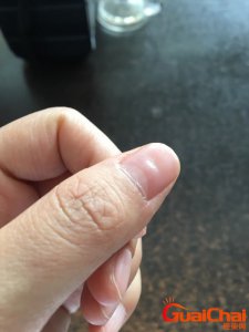 ​手指甲凹陷图片及原因？手指甲凹陷是什么原因造成的